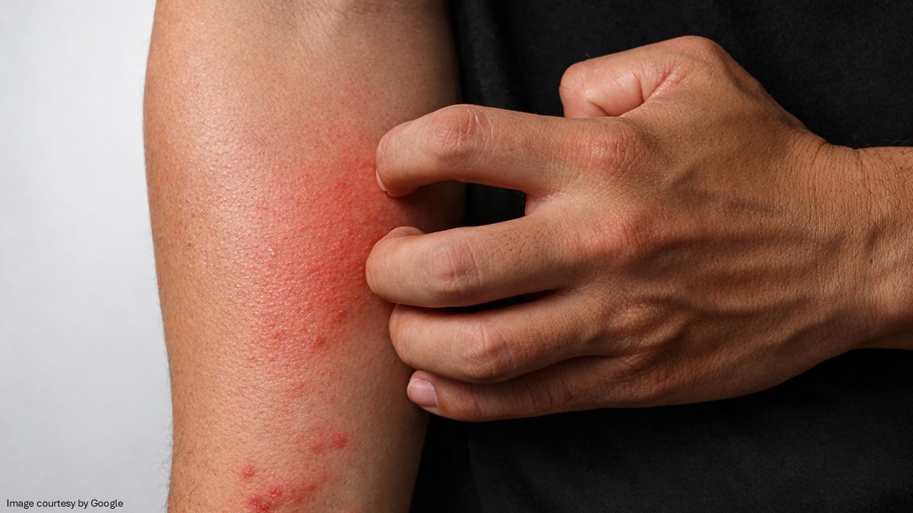 HIV Rashes and Other Skin Conditions Linked to HIV