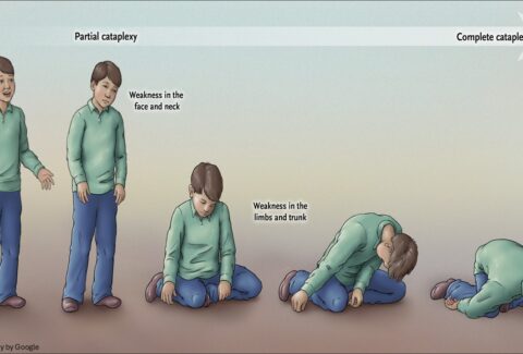 Narcolepsy stages