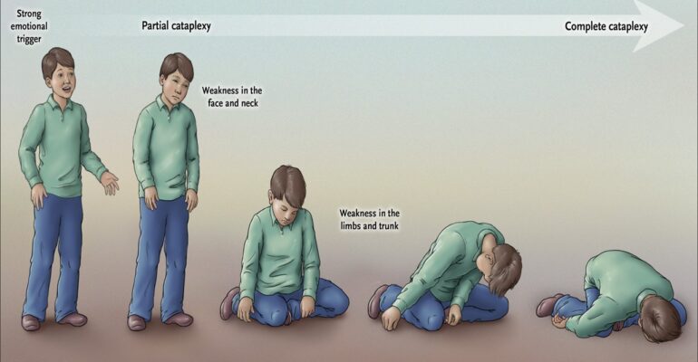 Narcolepsy stages