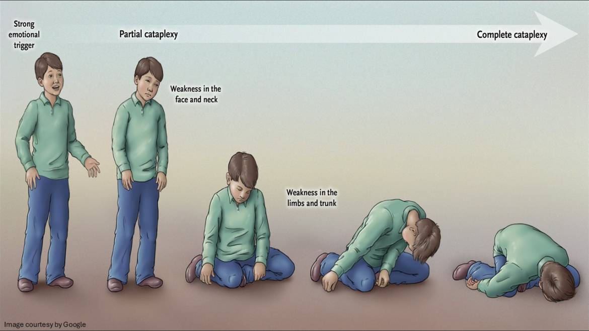 Narcolepsy: Causes, Symptoms, Diagnosis, and Treatment