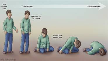 Narcolepsy: Causes, Symptoms, Diagnosis, and Treatment