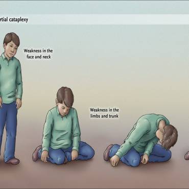Narcolepsy: Causes, Symptoms, Diagnosis, and Treatment