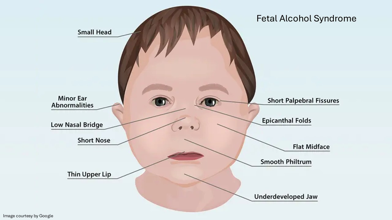 Fetal Alcohol Syndrome face of a baby