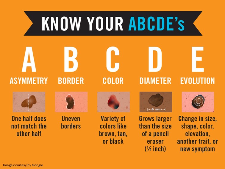 melanoma stages