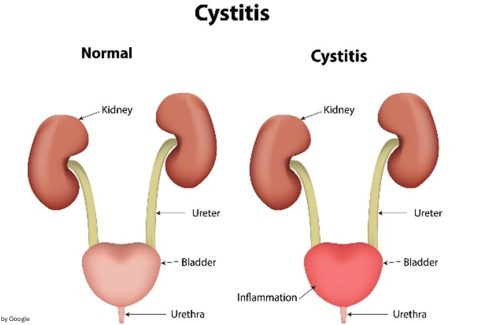 What Is Cystitis