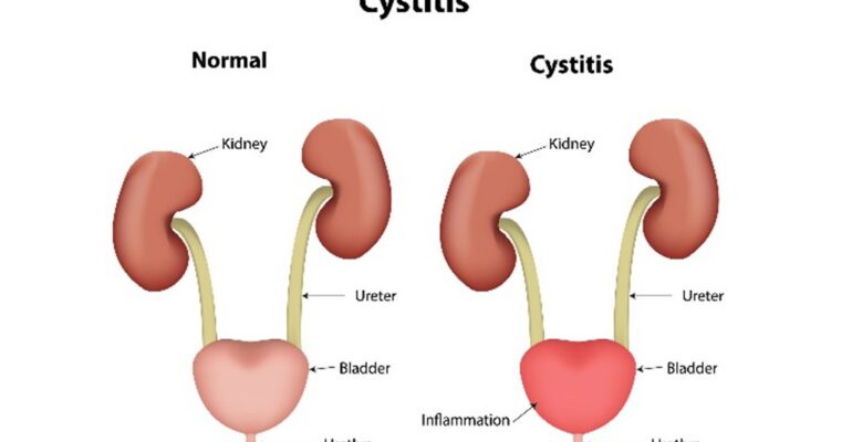 What Is Cystitis