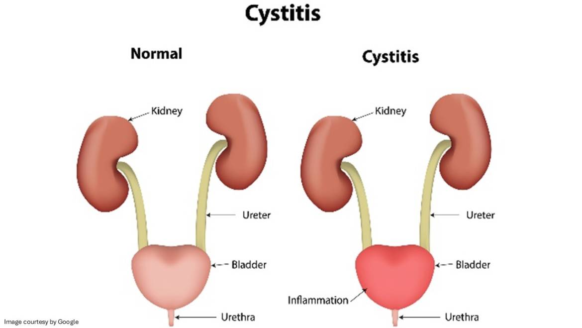 What Is Cystitis: Understand Causes, Symptoms and How to Prevent It