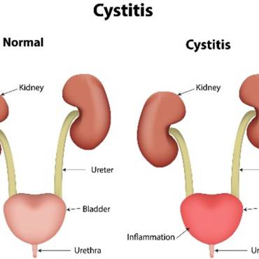 What Is Cystitis: Understand Causes, Symptoms and How to Prevent It