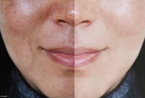 Comparison of Triple Combination Melasma Creams—Skin Lite, Tri-Luma, and Melamet—highlighting their ingredients, effectiveness, benefits, side effects, and suitability for melasma treatment.