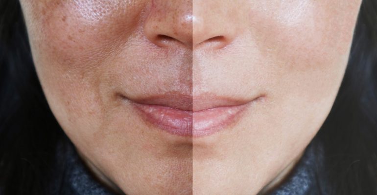 Comparison of Triple Combination Melasma Creams—Skin Lite, Tri-Luma, and Melamet—highlighting their ingredients, effectiveness, benefits, side effects, and suitability for melasma treatment.