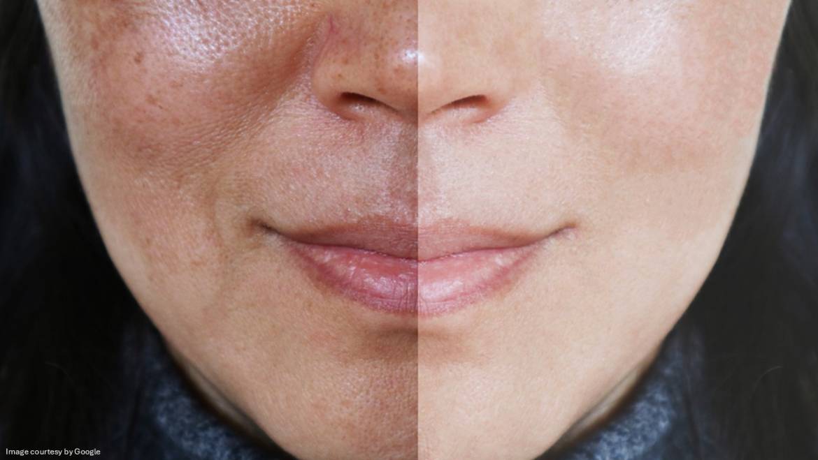 Triple Combination Melasma Creams — Skin Lite vs Tri-Luma vs Melamet