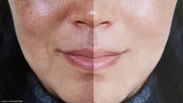 Triple Combination Melasma Creams — Skin Lite vs Tri-Luma vs Melamet