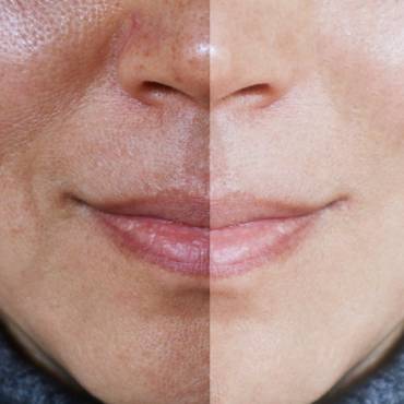 Triple Combination Melasma Creams — Skin Lite vs Tri-Luma vs Melamet