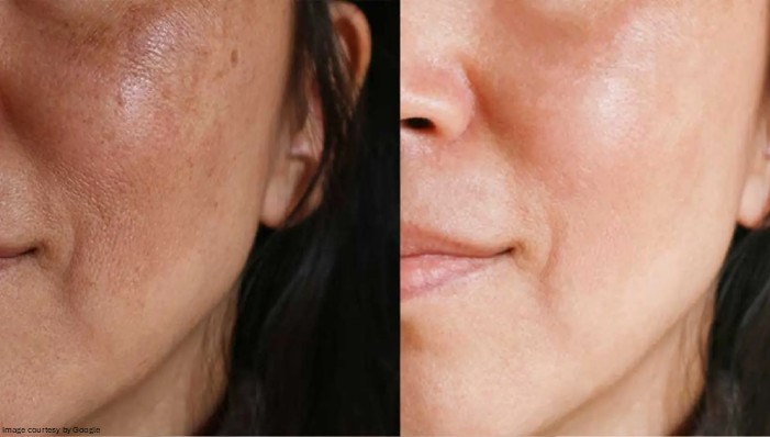 Melalite Forte vs Melamet — Which Melasma Cream Works Faster?