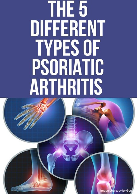 5 Types of Psoriatic Arthritis