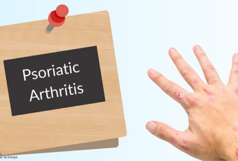 finger with psoriatic arthritis