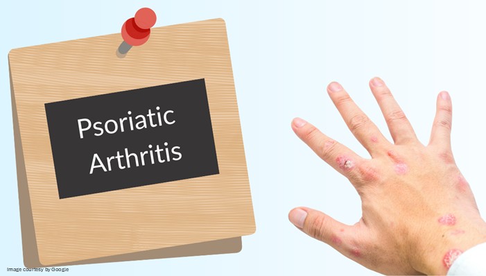 finger with psoriatic arthritis