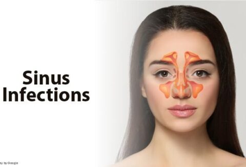 Levofloxacin for Sinus Infection
