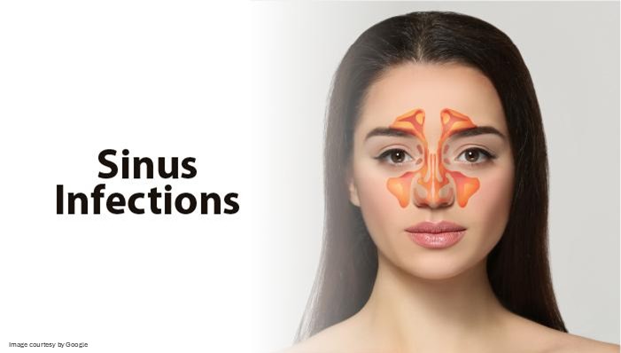 Levofloxacin for Sinus Infection