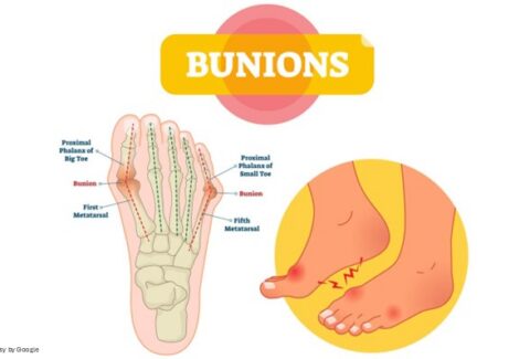 Signs of Bunions