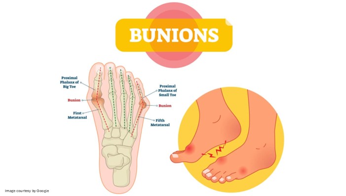 Signs of Bunions